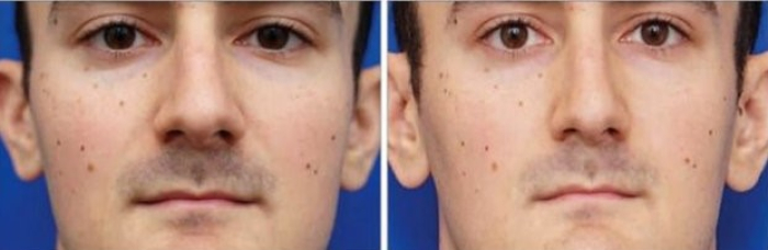 Ринопластика большого носа