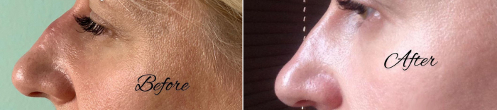 ринопластика без операции Галина Хрущ