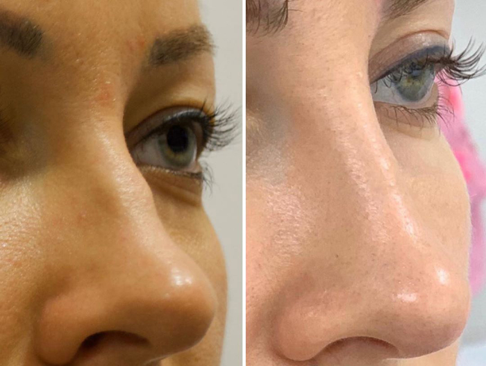 безоперационная ринопластика