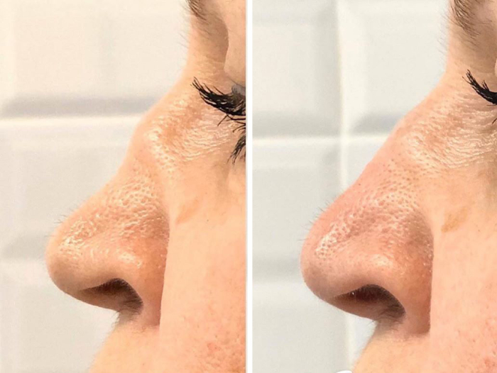 безоперационная ринопластика