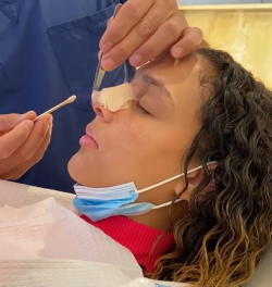 Уход за носом после ринопластики