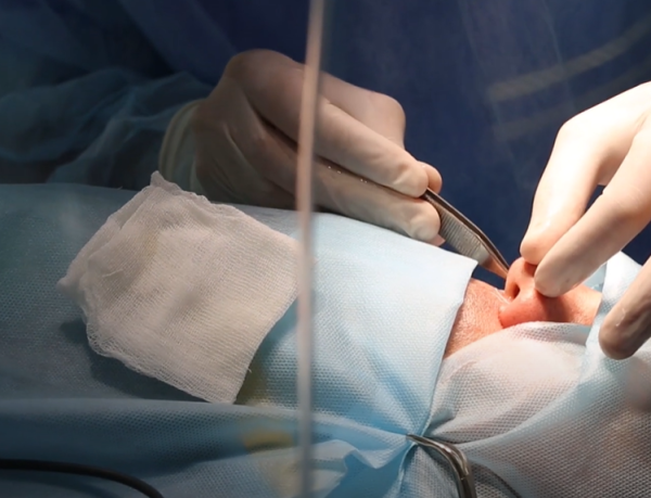 Ринопластика по сужению широкого носа