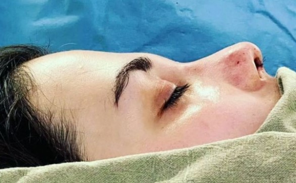 ринопластика фото носа