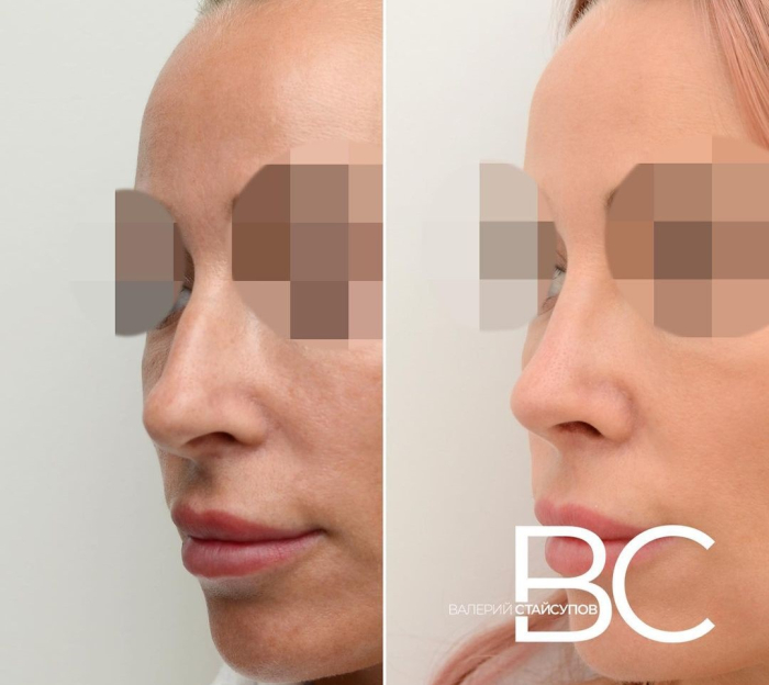 ринопластика уменьшение ноздрей