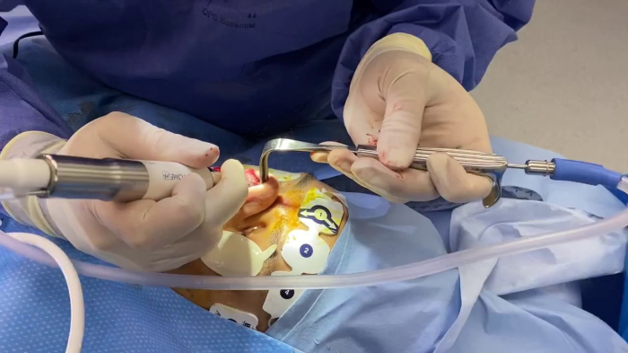 Процесс выполнения пьезоринопластики