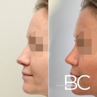 Закрытая ринопластика