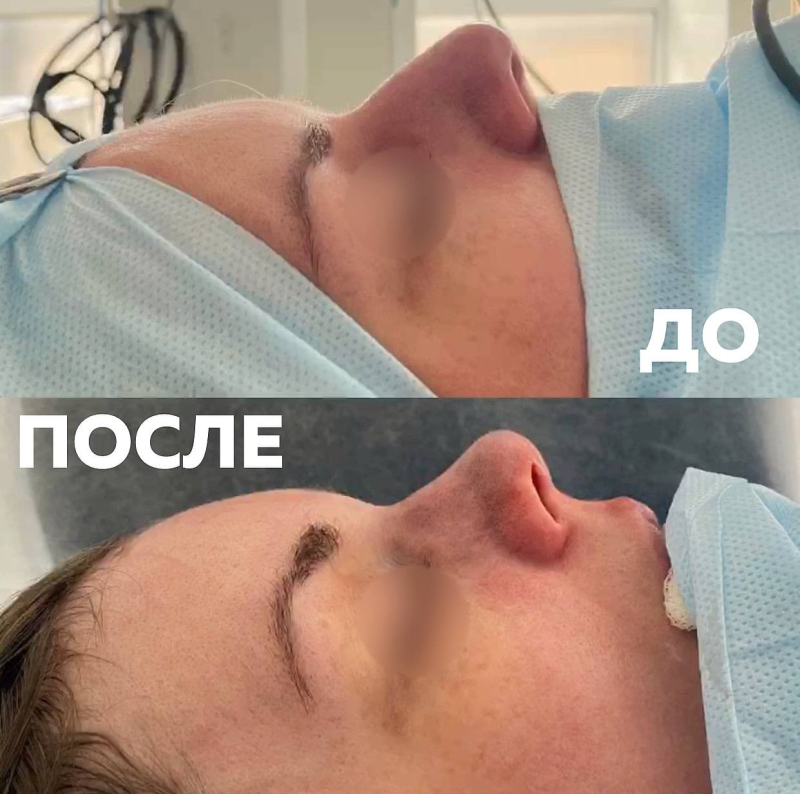 Пациентка до и после ринопластики в Москве у пластического хирурга Паруйра Минасяна