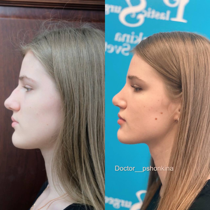 Пациентка пластического хирурга Светланы Пшонкиной до и после ринопластики