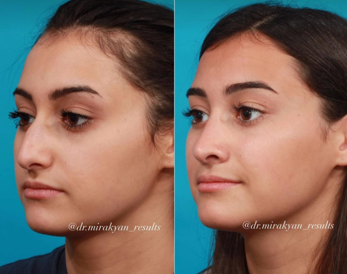 Пациентка до и после ринопластики. Оперировал пластический хирург Гукас Миракян