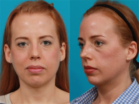 Фото пациентки пластического хирурга Гукаса Миракяна до и после сложной ринопластики