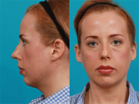 Фото пациентки пластического хирурга Гукаса Миракяна до и после сложной пластики носа