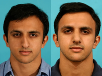 Пациент доктора Гукаса Миракяна. Фото до и после ринопластики. Снимок анфас