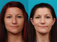 Пациентка доктора Гукаса Миракяна. Фото до и после ринопластики. Снимок анфас