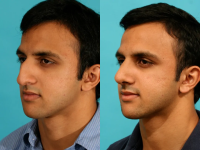 Пациент доктора Гукаса Миракяна. Фото до и после ринопластики. Снимок в полупрофиль