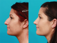 Пациентка доктора Гукаса Миракяна. Фото до и после ринопластики. Снимок в профиль