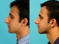 Пациент доктора Гукаса Миракяна. Фото до и после ринопластики. Снимок в профиль.