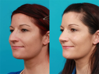 Пациентка доктора Гукаса Миракяна. Фото до и после ринопластики. Снимок в полупрофиль