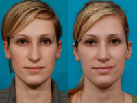 Пациент доктора Гукаса Миракяна. Фото до и после пластики носа. Снимок анфас