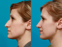 Пациент доктора Гукаса Миракяна. Фото до и после пластики носа. Снимок в профиль.