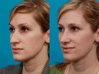 Пациент доктора Гукаса Миракяна. Фото до и после пластики носа. Снимок в полупрофиль