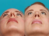 Фото пациентки пластического хирурга Гукаса Миракяна до и после сложной ринопластики носа с асимметрией