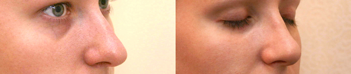 Александр Жуков ринопластика