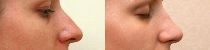 Александр Жуков ринопластика