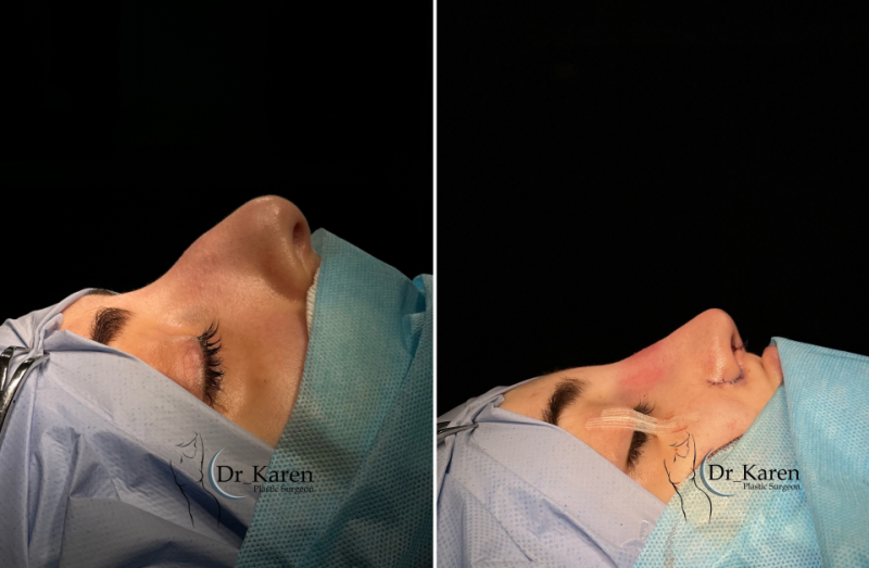 Пациентка до и после ринопластики у доктора Карена Пайтяна