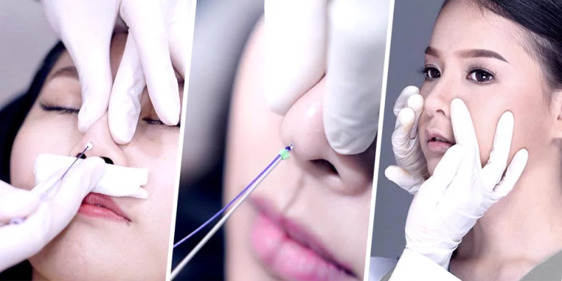 Как выполняется подтяжка носа нитями