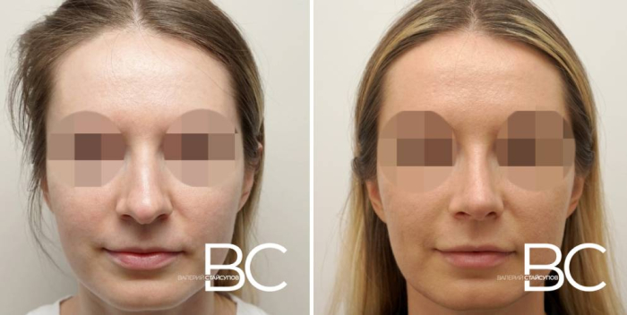 Пациентка доктора В. Стайсупова до и после ринопластики