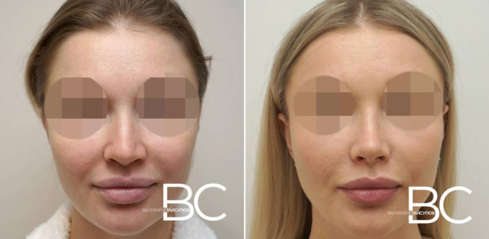 Пациентка доктора В. Стайсупова до и после ринопластики