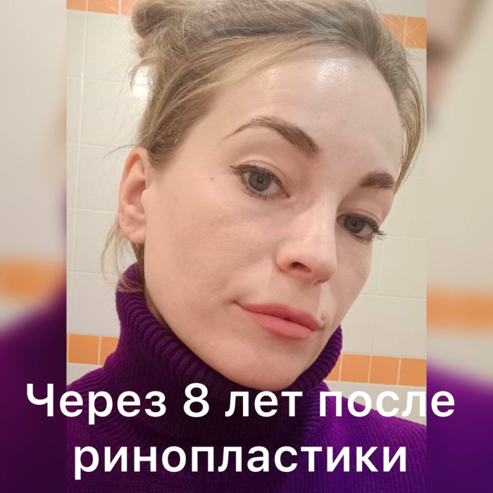 Пациентка через 8 лет после ринопластики