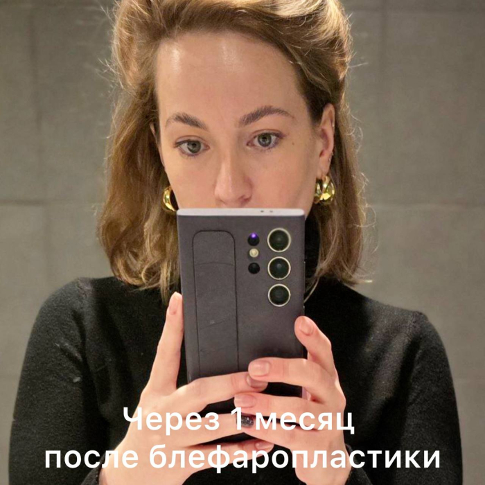 Через 1 месяц после блефаропластики